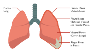 mesothelioma-300x167.png